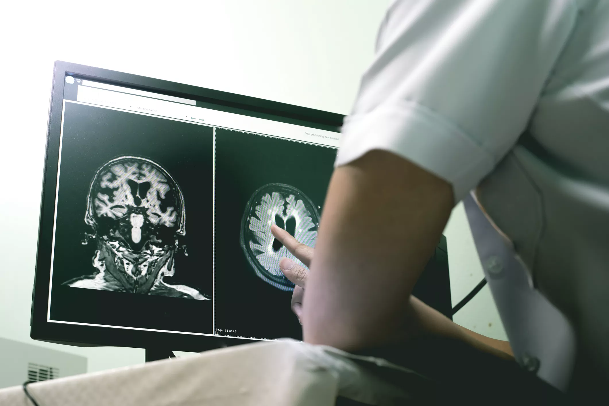 Factori care predispun la Alzheimer cu debut timpuriu, mai agresiv decât cel care apare la bătrânețe – studiu